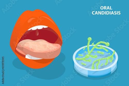 3D Isometric Flat Vector Conceptual Illustration of Oral Candidiasis, Yeast Infection
