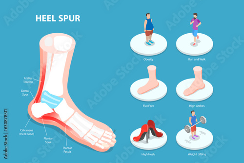 3D Isometric Flat Vector Conceptual Illustration of Heel Spur, Calcaneal Bone Condition