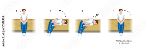 Appiani maneuver right side
