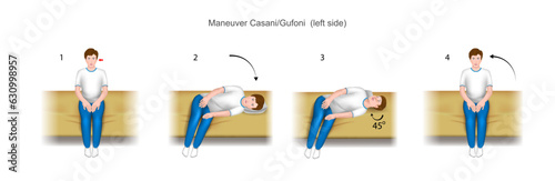 Casani Gufoni maneuver left side