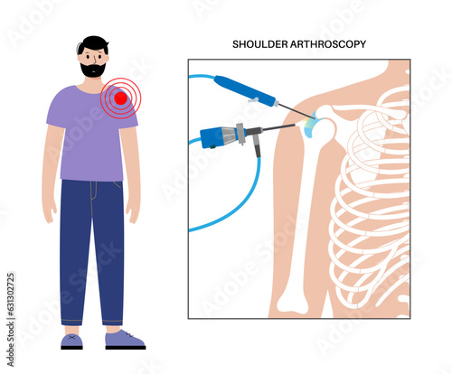 Shoulder arthroscopy poster