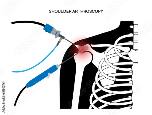 Shoulder arthroscopy poster