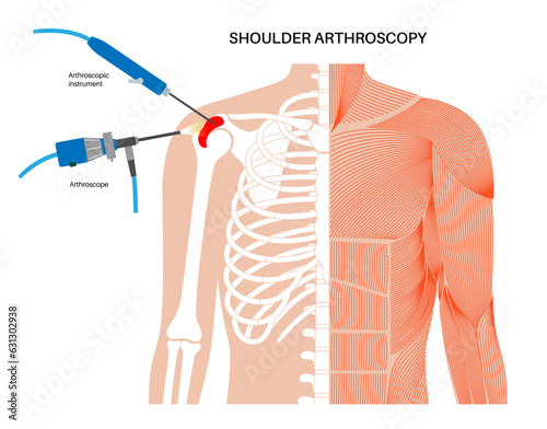 Shoulder arthroscopy poster