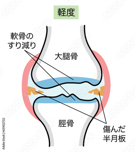 軽症の変形性膝関節症のシンプルな説明イラスト