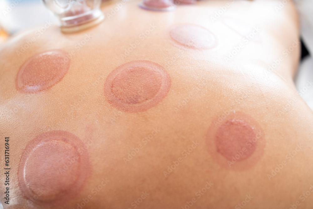 Wet cupping marks and cuts on patient after hijama treatment.