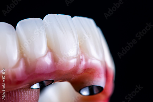 dental photography of full arch zircon bridge on implants
