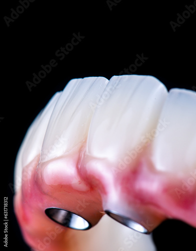 dental photography of full arch zircon bridge on implants