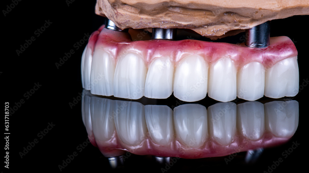 Obraz premium dental photography of full arch zircon bridge on implants