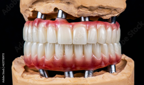 dental photography of full arch zircon bridge on implants