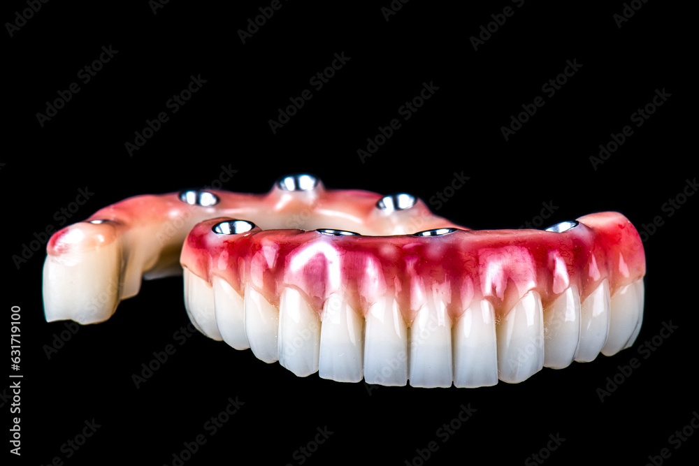 dental photography of full arch zircon bridge on implants dental photography of full arch zircon bridge on implants
