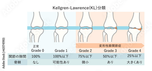 変形性膝関節症の進行度(KL分類)のイラスト