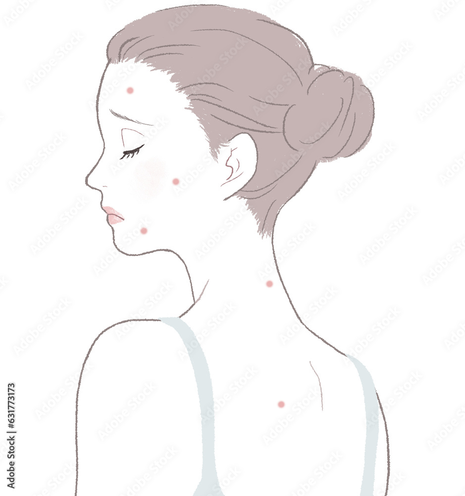 ニキビに悩む女性 ニキビに悩む女性
