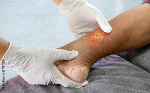 doctor wearing a white hygienic glove and holding an elderly woman's leg to check for gangrene due to diabetes. concept of healthcare and occupational health photo