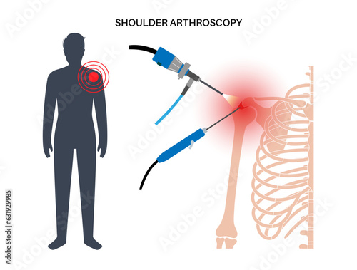 Shoulder arthroscopy poster