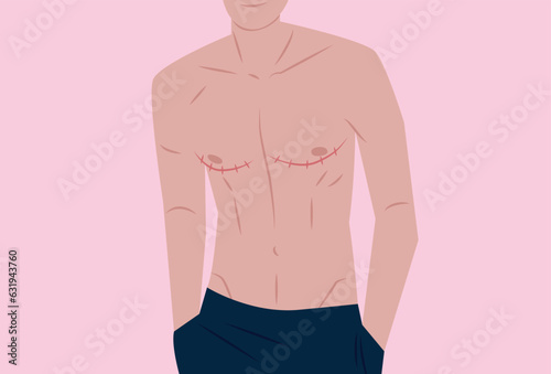 Shirtless Trans Man Proudly Showing Top Surgery Scars, FTM, Transgender, Post-Op Medical Surgery photo