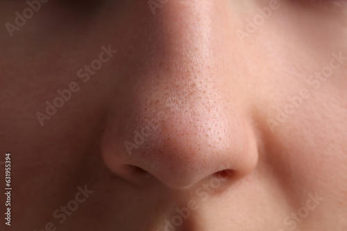 Young woman with acne problem, closeup view of nose