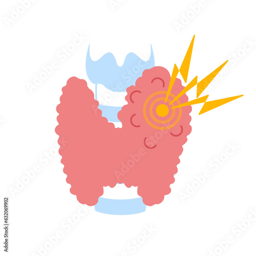 Enlarged thyroid gland lobe. Goiter icon. Thyroid hormones function imbalance. Endocrine system disease. Hyperthyroidism and hypothyroidism. Overactive organ. Isolated flat vector illustration.