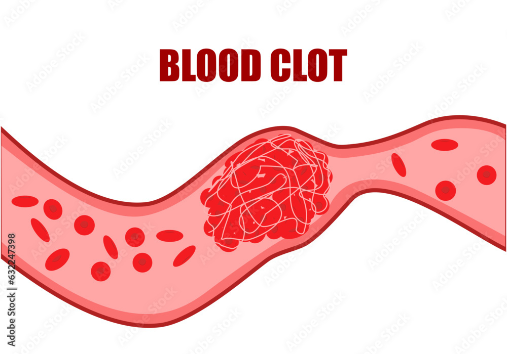 Blood clots are semisolid or gellike masses that form in your