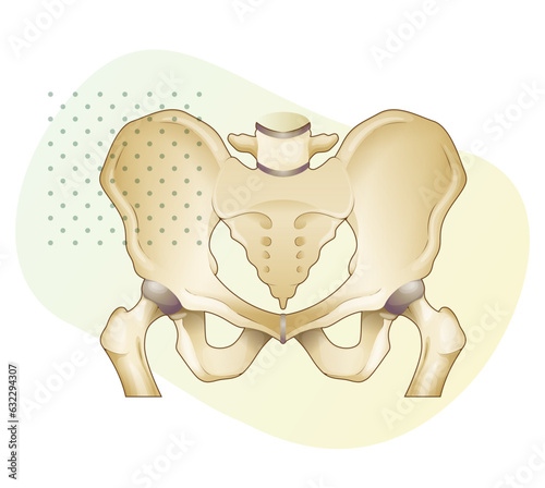 Osteoarthritis - Bone Death - Hip Joint - Stock Illustration