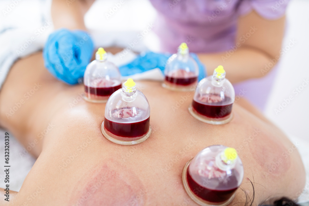 Ταπετσαρία Wet cupping or bloodletting hijama treatment performed on patient back