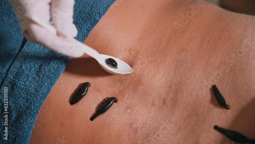 Treatment with leeches. A doctor performs a hirudotherapy procedure for a man. A doctor plants leeches on a man's back. The help of leeches for the treatment of the body. Alternative medicine. photo