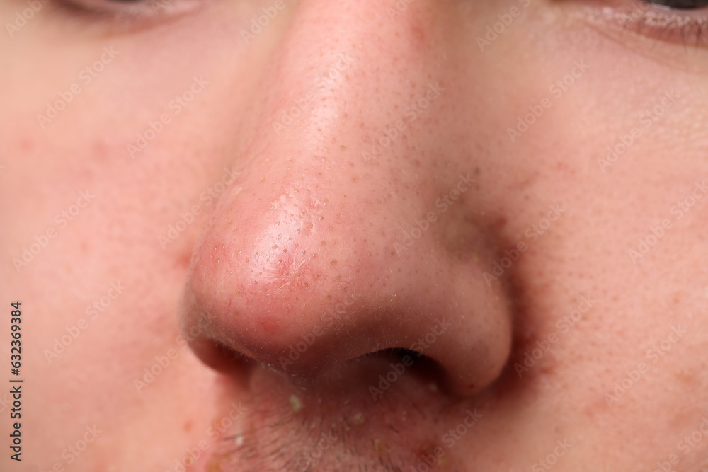 Young man with acne problem, closeup view of nose Young man with acne problem, closeup view of nose