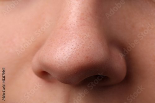 Young woman with acne problem, closeup view of nose