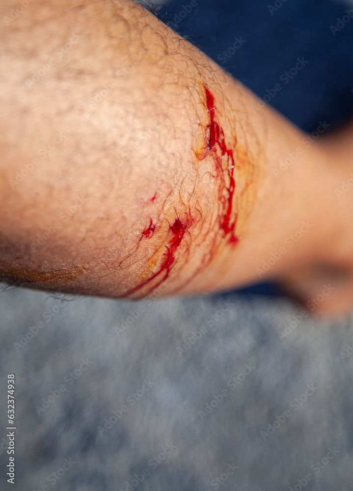 Naklejka premium Dog bites leg bleeding wound