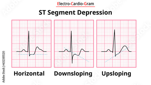 ECG Morphology of ST Segment Depression - Horizontal, Upsloping, and Downsloping - Medical Electrocardiogram Vector Illustration photo