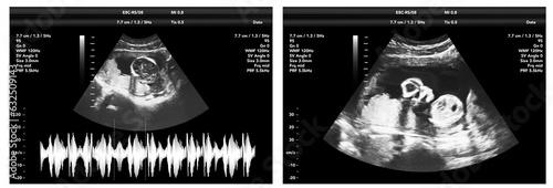 pregnancy ultrasound film genecology sonogram, baby medical ultra scan diagnostic control