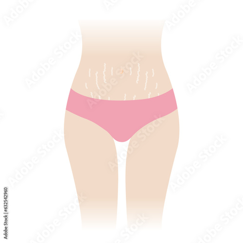 Stretch marks on tummy vector illustration isolated on white background. The white stretch marks appear on the abdomen, mid stomach, belly of woman body. Skin care and beauty concept.