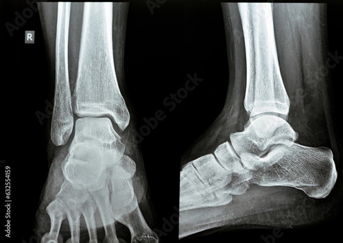 Plain x-ray AP Lateral views of the right ankle showing syndesmotic ankle sprain, an injury to one or more of ligaments comprising the distal tibiofibular syndesmosis, high ankle sprain, twisted ankle