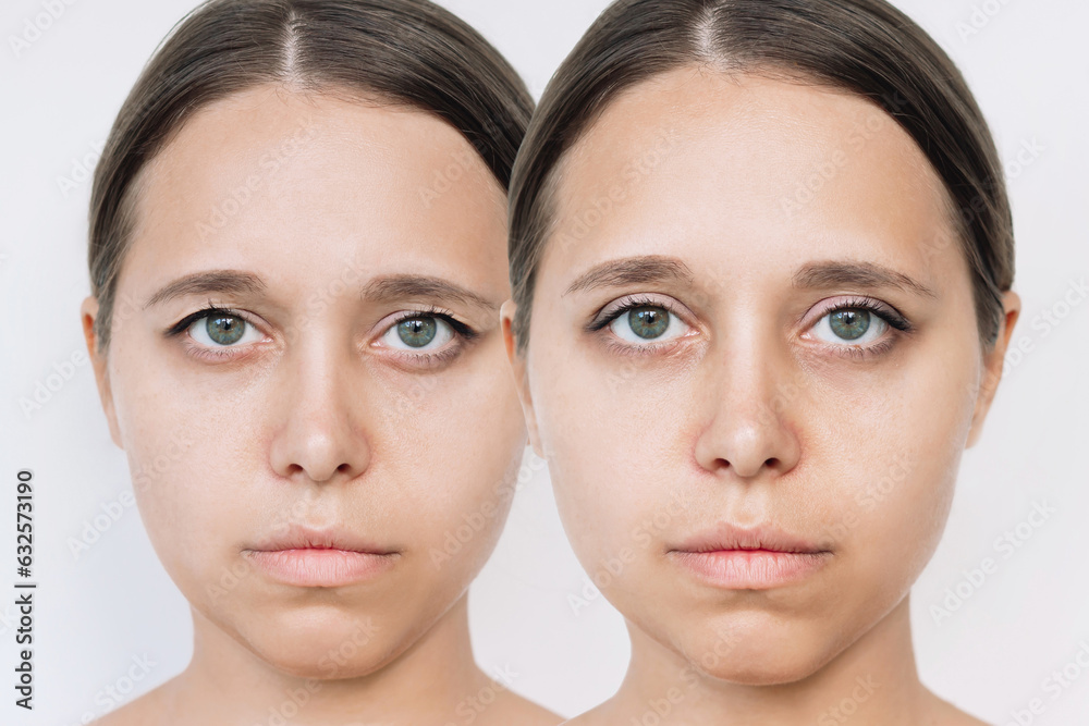 Young attractive caucasian woman's face with drooping upper eyelid