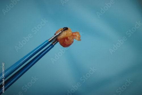 photo of human eye fats removed from the eye during blepharoplastic surgery