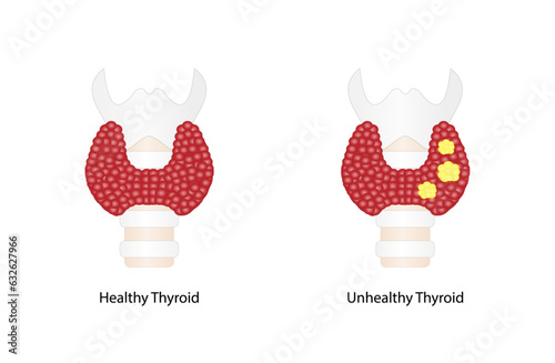 Thyroid cancer, unhealthy thyroid with Inflammation and lump. Vector illustration isolated on white background.