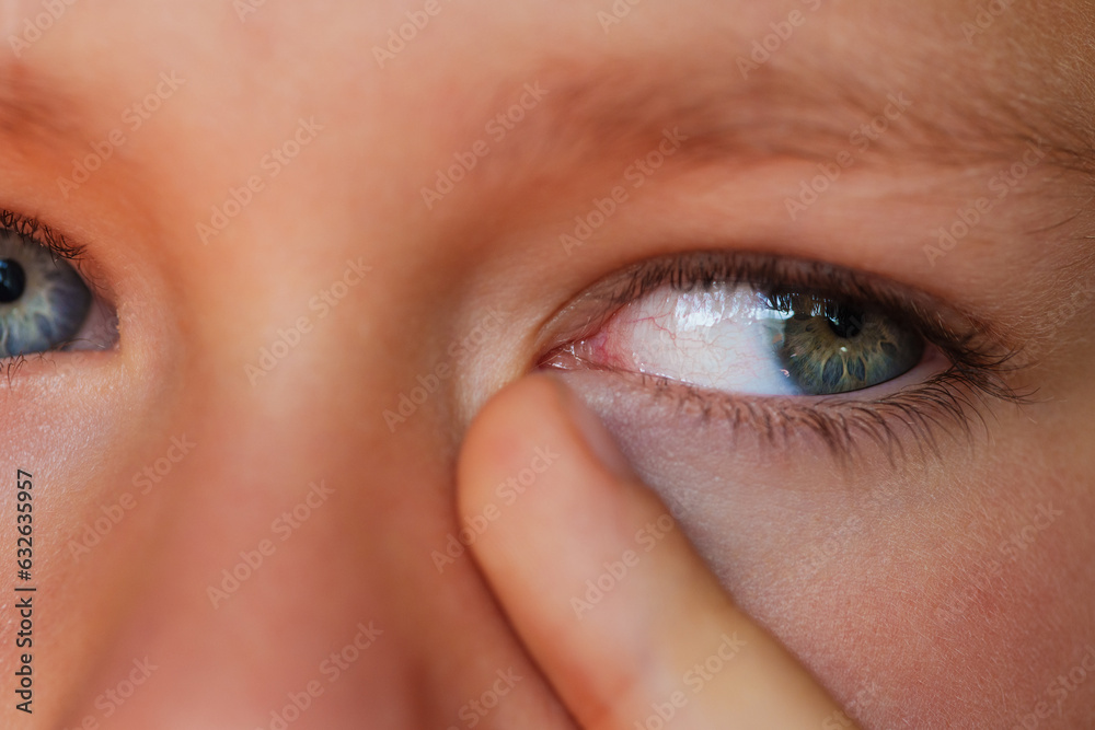 Fototapeta premium Allergic boy scratching his eyes close-up view