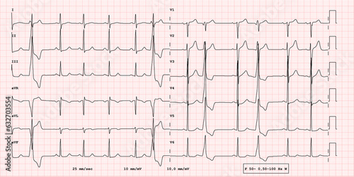 ECG example of 12-lead rhythm, Ventricular Bigeminy, real exam