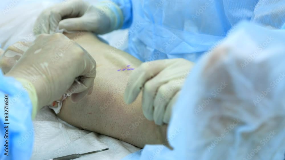 Phleboextractor surgeon removes from small hole in the patient's leg the affected part of the vein for the treatment of varicose veins. Surgeon and assistant perform surgery to remove varicose veins Phleboextractor surgeon removes from small hole in the patient's leg the affected part of the vein for the treatment of varicose veins. Surgeon and assistant perform surgery to remove varicose veins