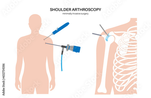 Shoulder arthroscopy poster