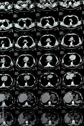 Multi slice CT scan of the chest showing normal study, normal appearance of the lungs, parenchyma, pulmonary vasculature,  mediastinal structures, no adenopathy, no pleural effusion, no abnormality photo