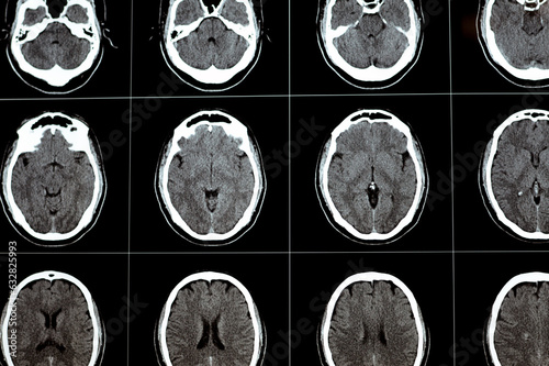Brain CT scan showing brainstem cavernoma, right centrum semiovale developmental venous anomaly, intra cerebral haematoma, faint hypodense lesion in medulla oblongata and pontomedullary junction photo