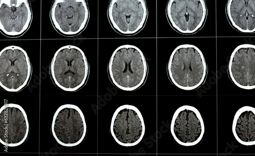 Brain CT scan showing brainstem cavernoma, right centrum semiovale developmental venous anomaly, intra cerebral haematoma, faint hypodense lesion in medulla oblongata and pontomedullary junction