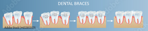 Dental teeth braces installation steps vector poster