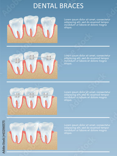 Dental braces infographic brochure orthodontic dentistry poster