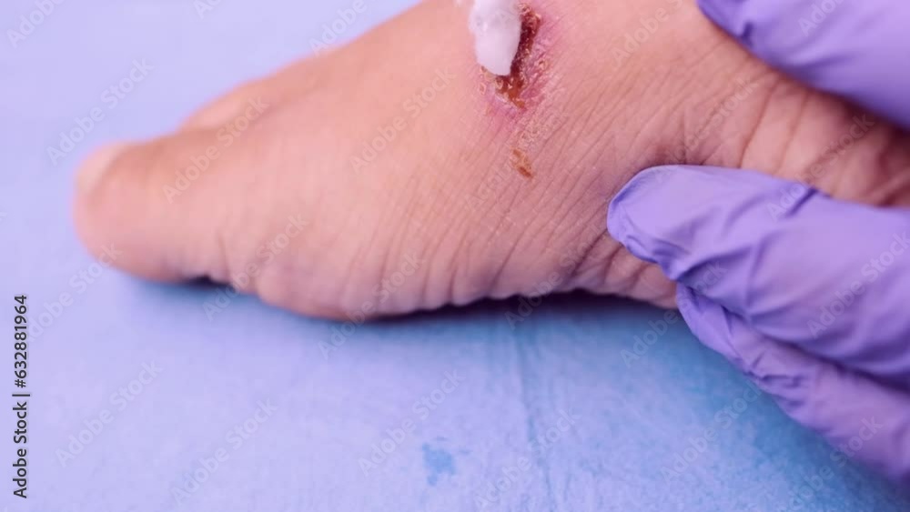doctor treats weeping wound, trophic ulcer on female leg, wound exudate(04)