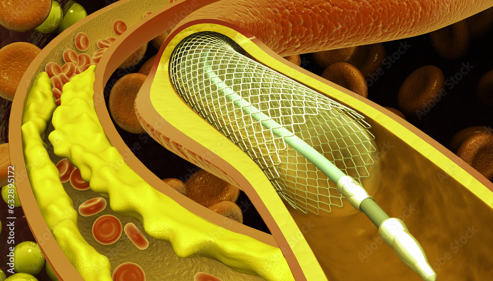 Cholesterol blockage with stent in artery. 3d illustration. Cholesterol blockage with stent in artery. 3d illustration.