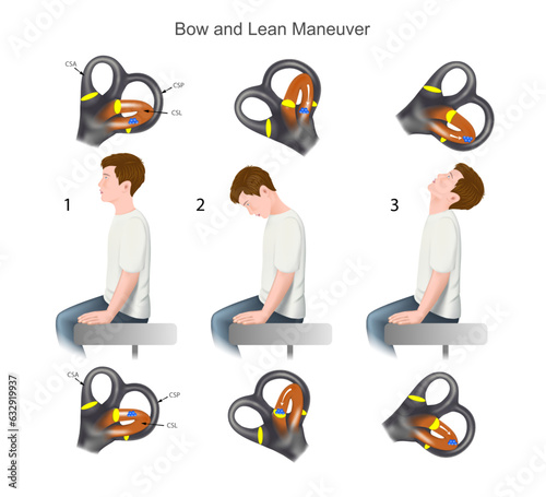Vestibular Tests Bow and Lean Maneuver