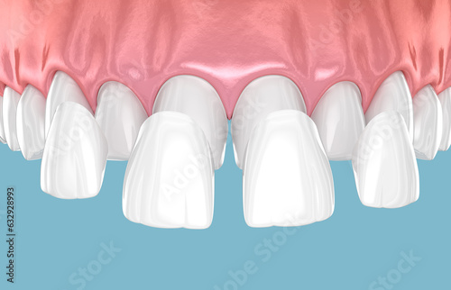 Dental veneer placement over frontal teeth. 3D illustration