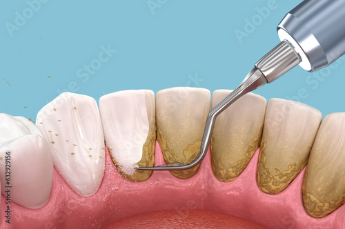 Foto Oral hygiene: Scaling and root planing (conventional periodontal therapy)