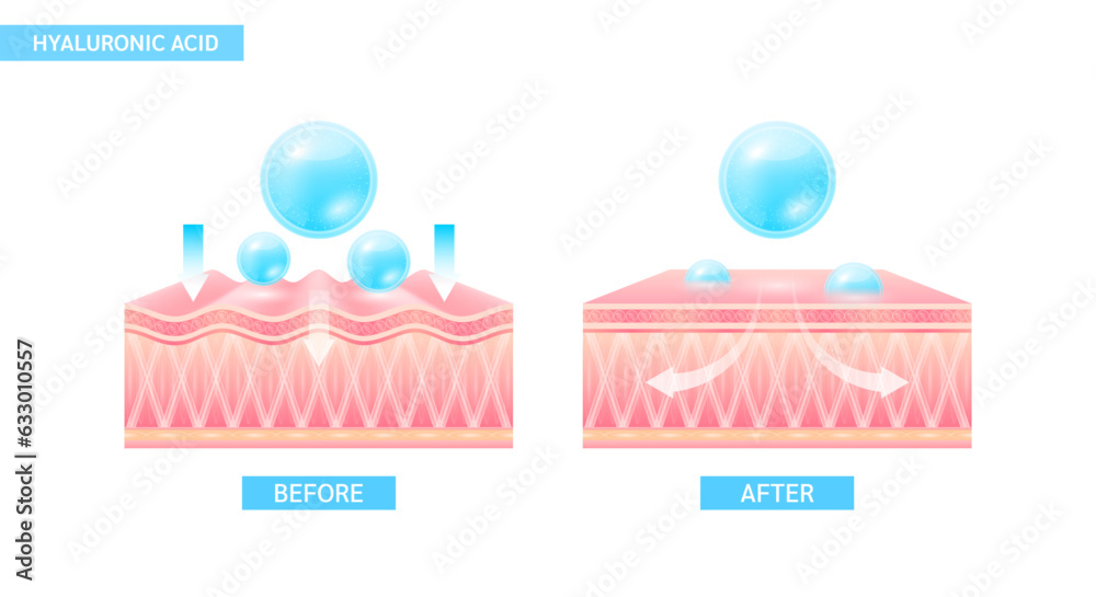 Hyaluronic acid serum drop blue absorbed into the skin cell. Before and ...